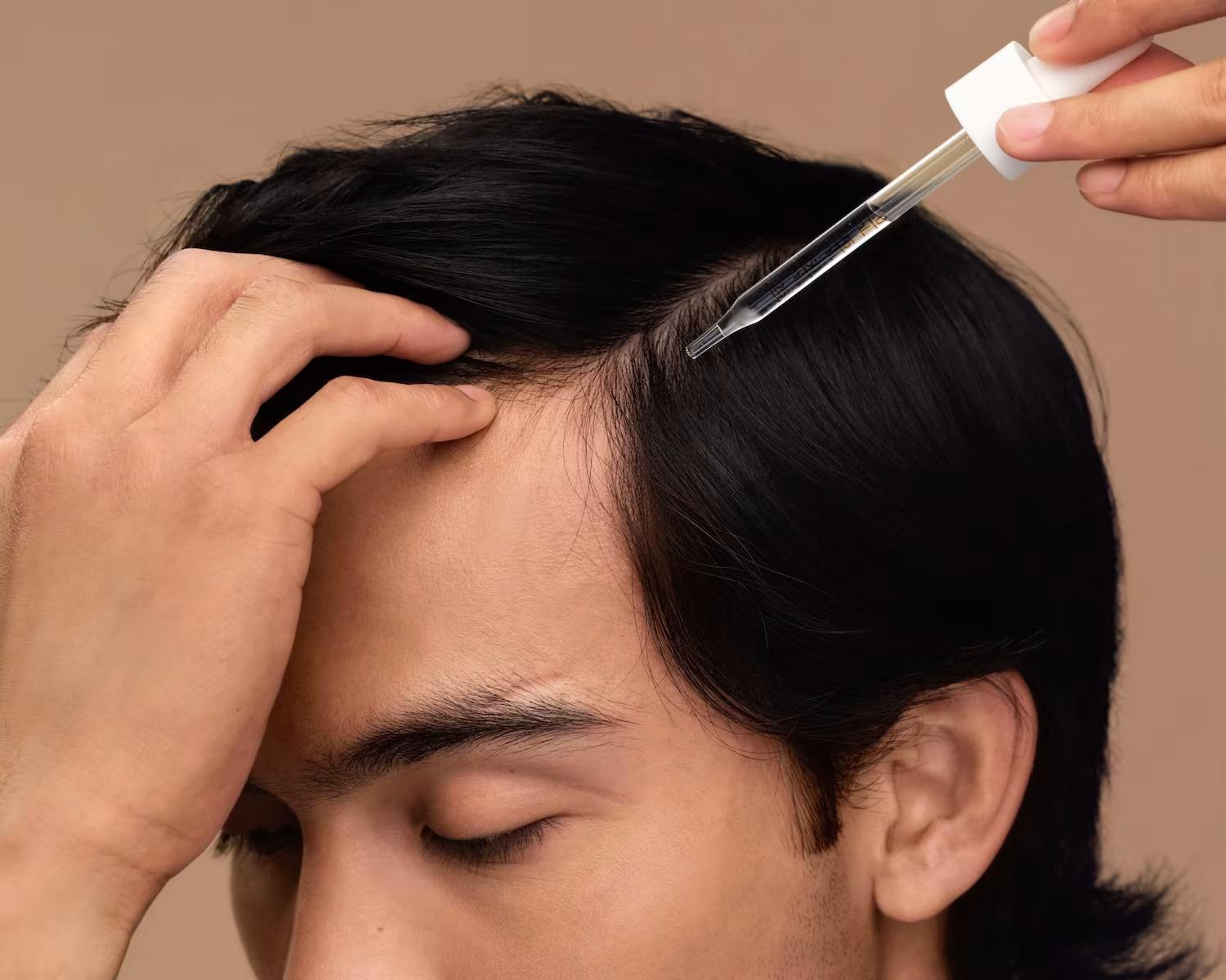 Is an M-Shaped Hairline a Sign of Balding?